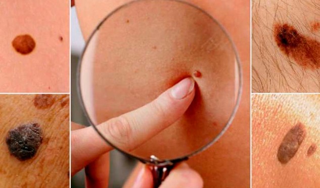 Aumenta la incidencia de cáncer de piel en la región insular