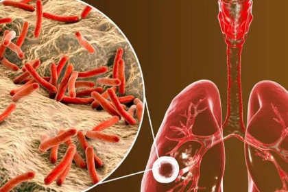 Alertan aumento de casos de tuberculosis en Nueva Esparta