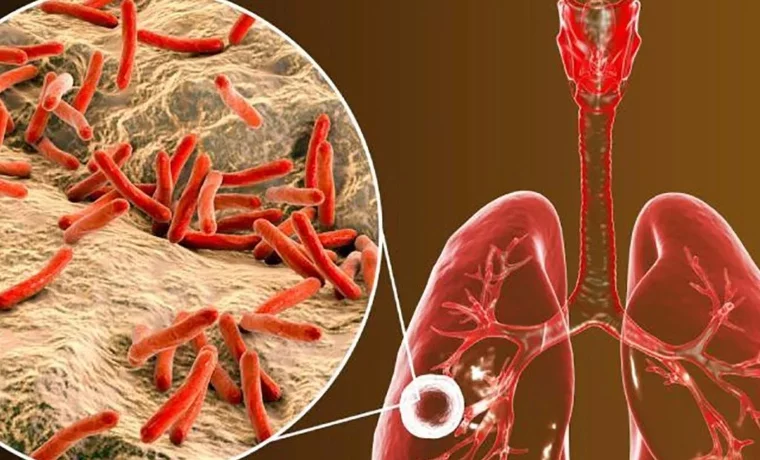 Alertan aumento de casos de tuberculosis en Nueva Esparta