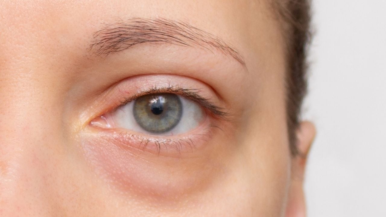 El eficaz remedio casero que desinflama las bolsas de los ojos y elimina las ojeras en 5 minutos