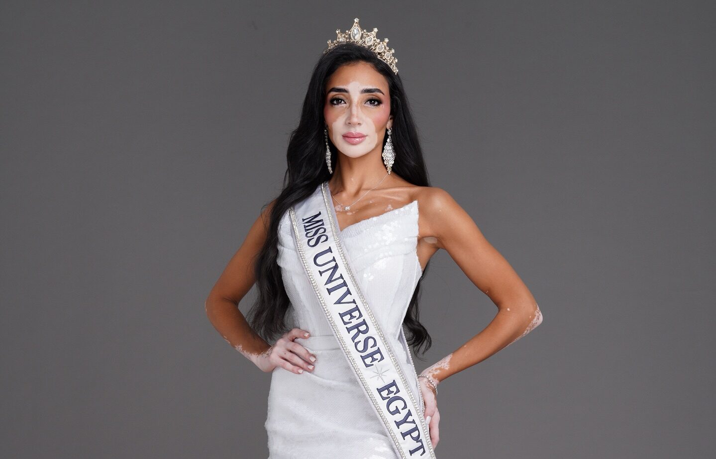 Esta es la primera candidata que tiene el Miss Universo con vitiligo